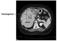 leverhemangioom-CT-scan-300x218